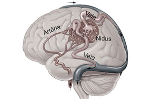 Malformações arteriovenosas cerebrais: qual é o melhor caminho para tratar?