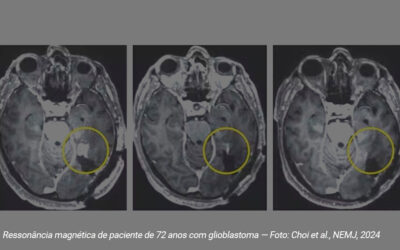 Terapia com células CAR-T pode ser o futuro para tratamento de tumor cerebral