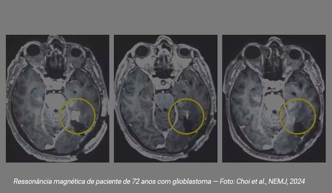 Terapia com células CAR-T pode ser o futuro para tratamento de tumor cerebral