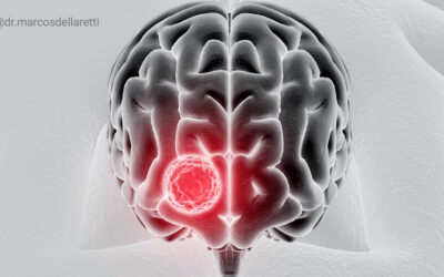 Entenda as principais diferenças entre os tumores cerebrais