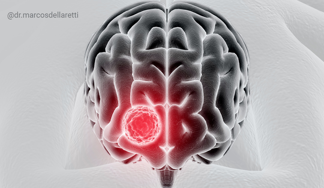 Entenda as principais diferenças entre os tumores cerebrais