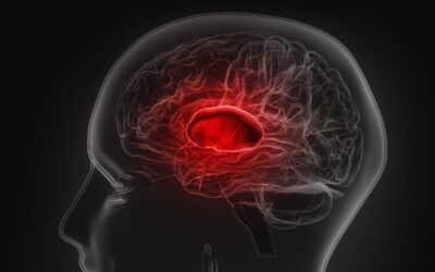 Tumor cerebral: 6 perguntas e respostas para entender a condição