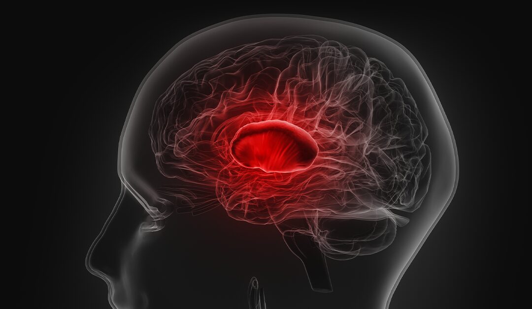 Tumor cerebral: 6 perguntas e respostas para entender a condição