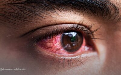 Zumbido pulsátil e olhos vermelhos: sintomas que podem indicar fístula dural, um diagnóstico que merece atenção