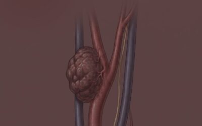 Paraganglioma Timpânico x jugular: como a localização altera a estratégia cirúrgica
