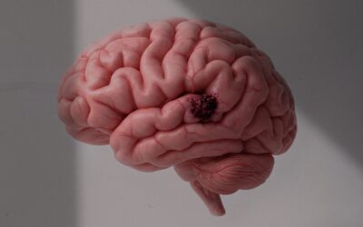 Pequenas “amoras” no cérebro: o que é o cavernoma e como eu avalio o risco de sangramento
